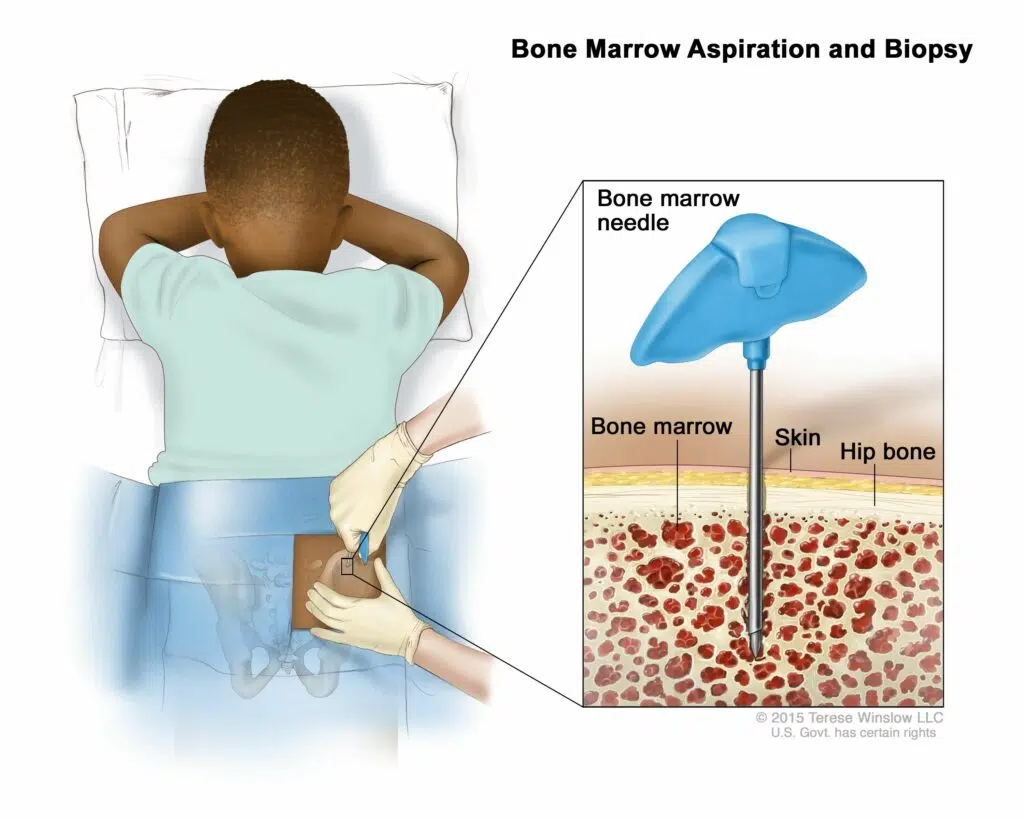 ما هي عملية زراعة نخاع العظم؟
