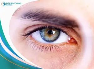 e71c41568d699bedec578e62fa1be1c8 درمان آب سیاه چشم در ترکیه