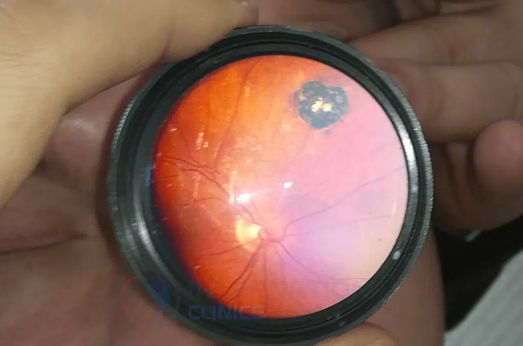 indirect ophthalmoscopy lenses