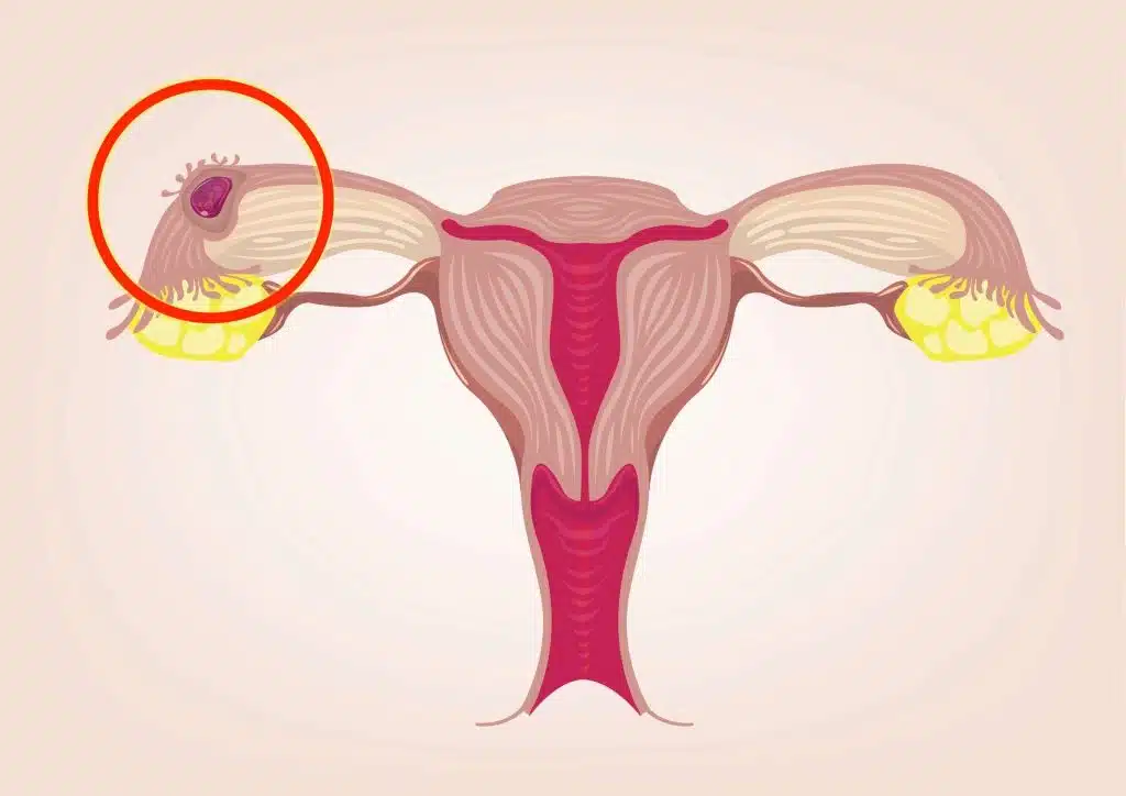 ما طبيعة الحمل خارج الرحم؟