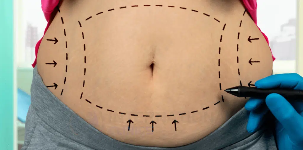 tummy tuck gone wrong pictures