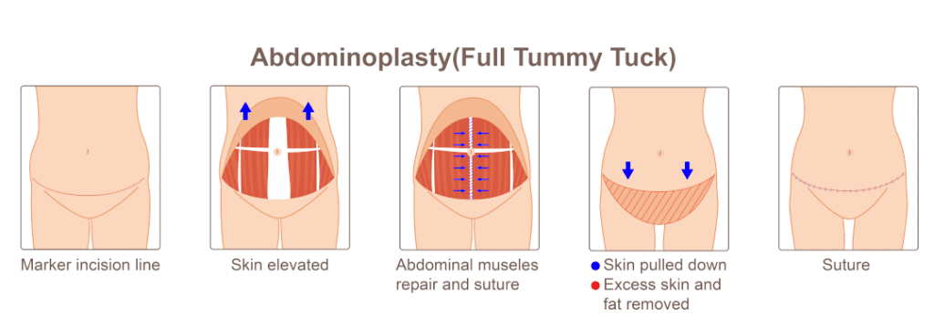 Tummy Tuck Negligence Claims – How Much Compensation Could I Claim? 