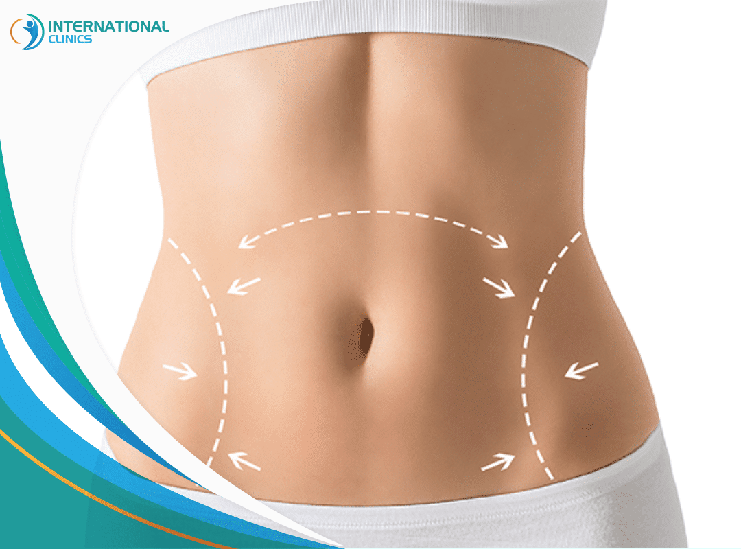 Tummy Tuck Gone Wrong: What Actually Happened? - International Clinics
