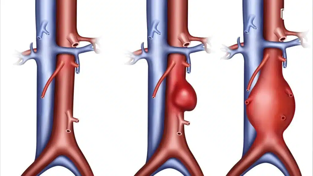 ما هو تمدد الأوعية الدموية الأبهري (Thoracic aortic aneurysm)