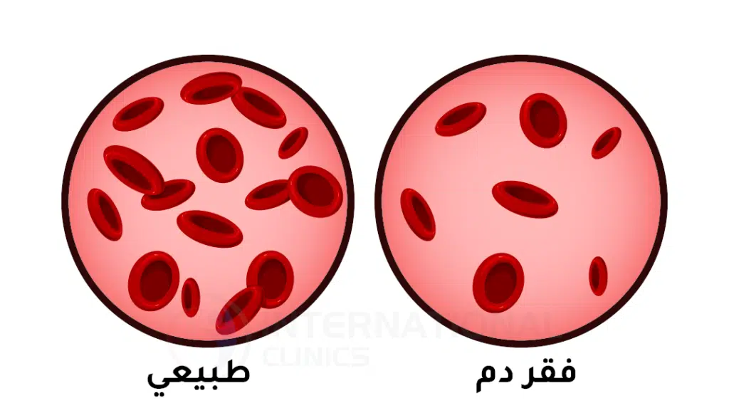 أعراض فقر الدم عند الأطفال