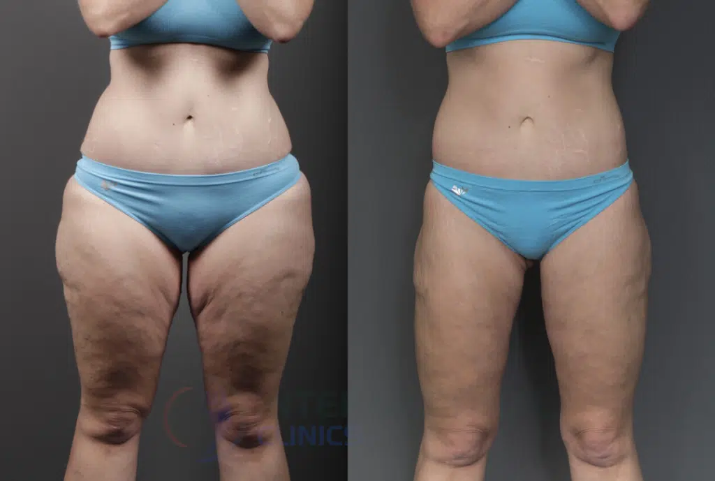 Leg Liposuction Before and After