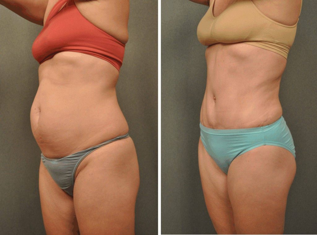 Smart Lipo Before and After 2 Months - International Clinics