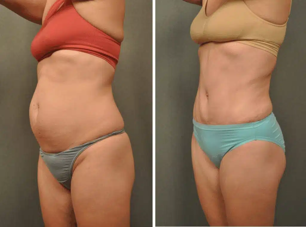 Smart Lipo Before and After 2 Months image