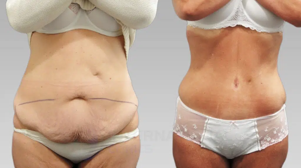 Plus Size Lipo 360 Before and After