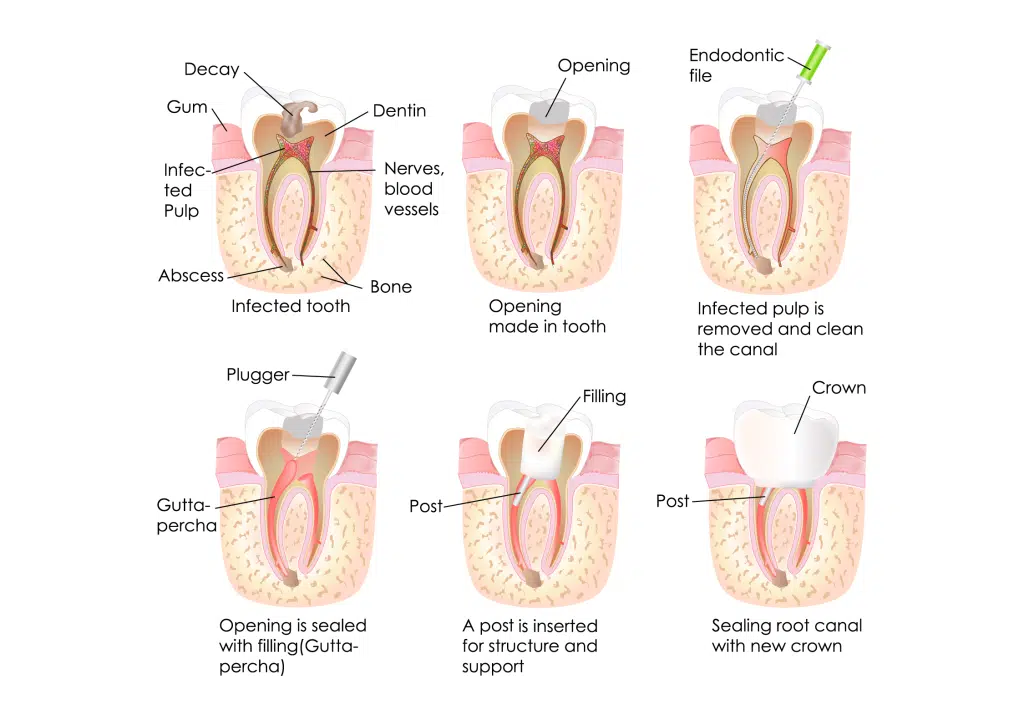 Endodontics Procedure
