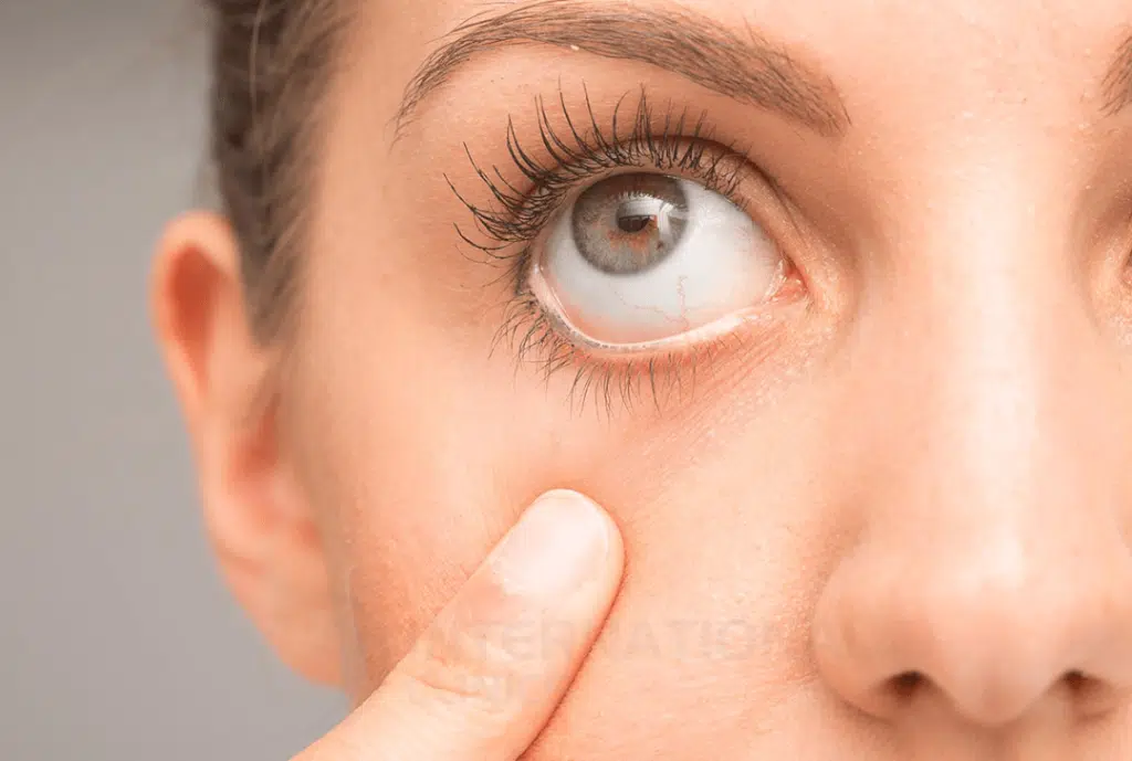 treatment for dry eyes syndrome