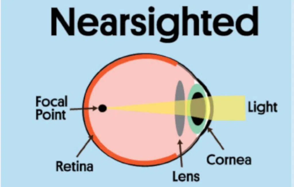 What Is Nearsightedness