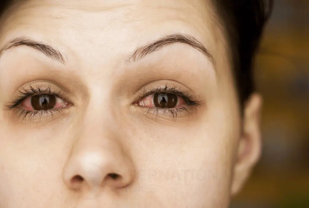 long term complications of dry eyes