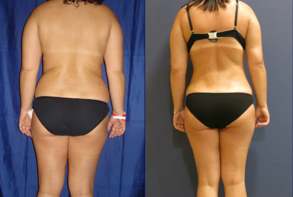 Back Liposuction Before and After