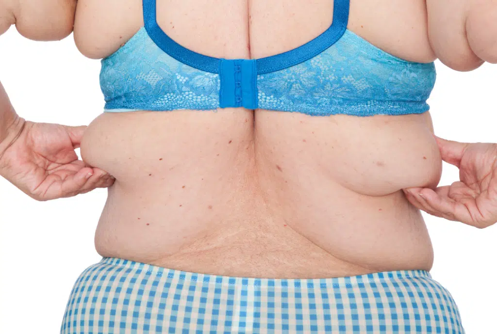 Back Liposuction procedure