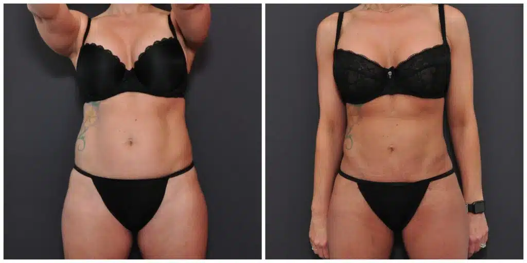 Vaser Liposuction Before and After