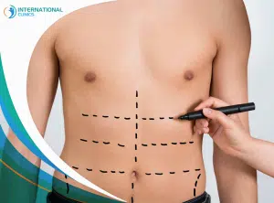 Power-Assisted Liposuction