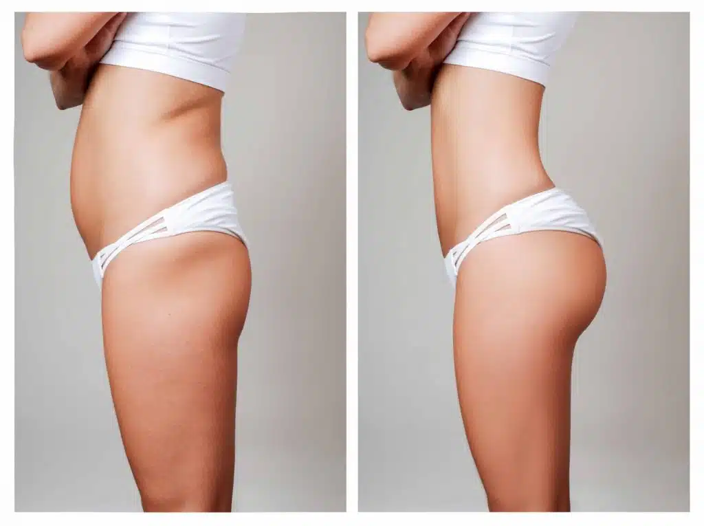 Smart Lipo Before and After 2 Months picture
