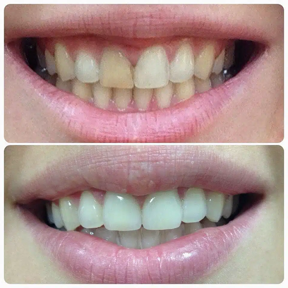 gum disease before and after pictures