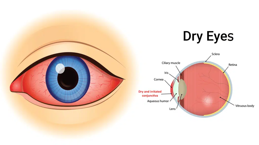 Symptoms of Dry Eyes Syndrome