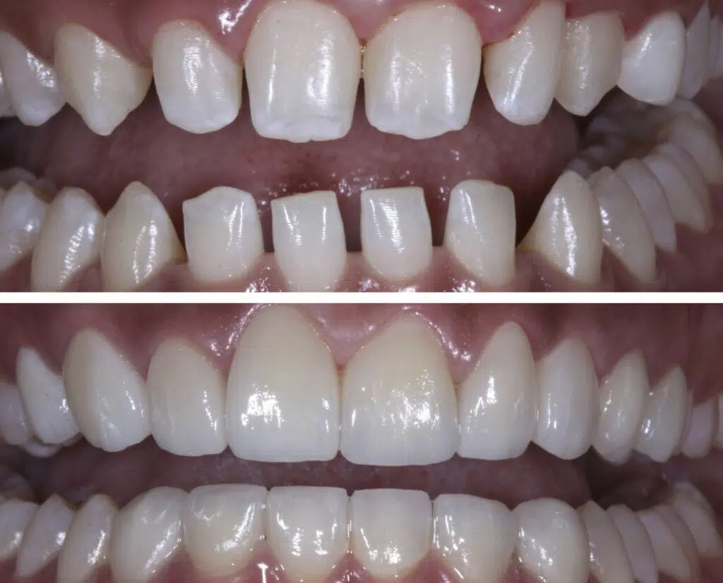 gum disease before and after images
