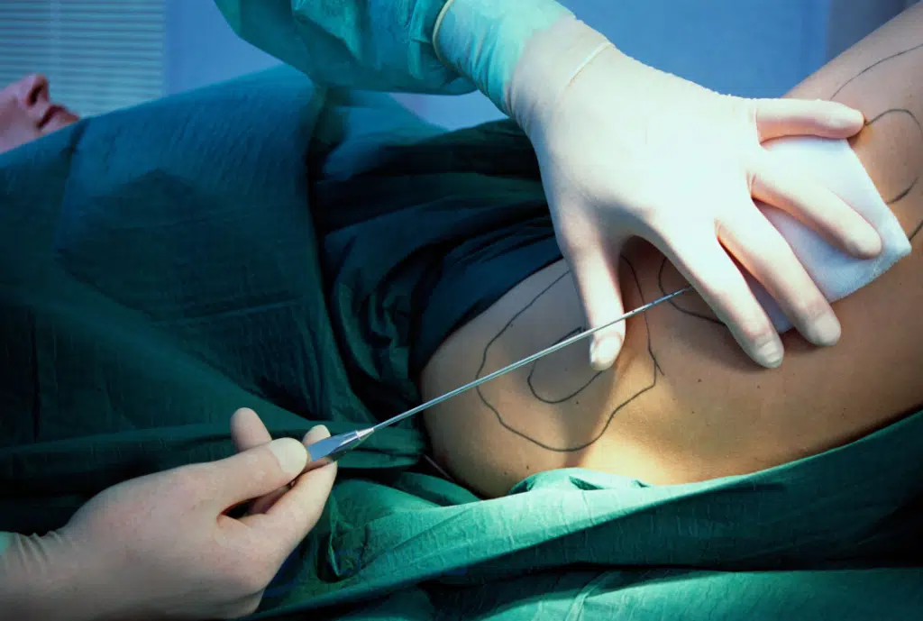 Advantages of Suction Assisted Lipectomy