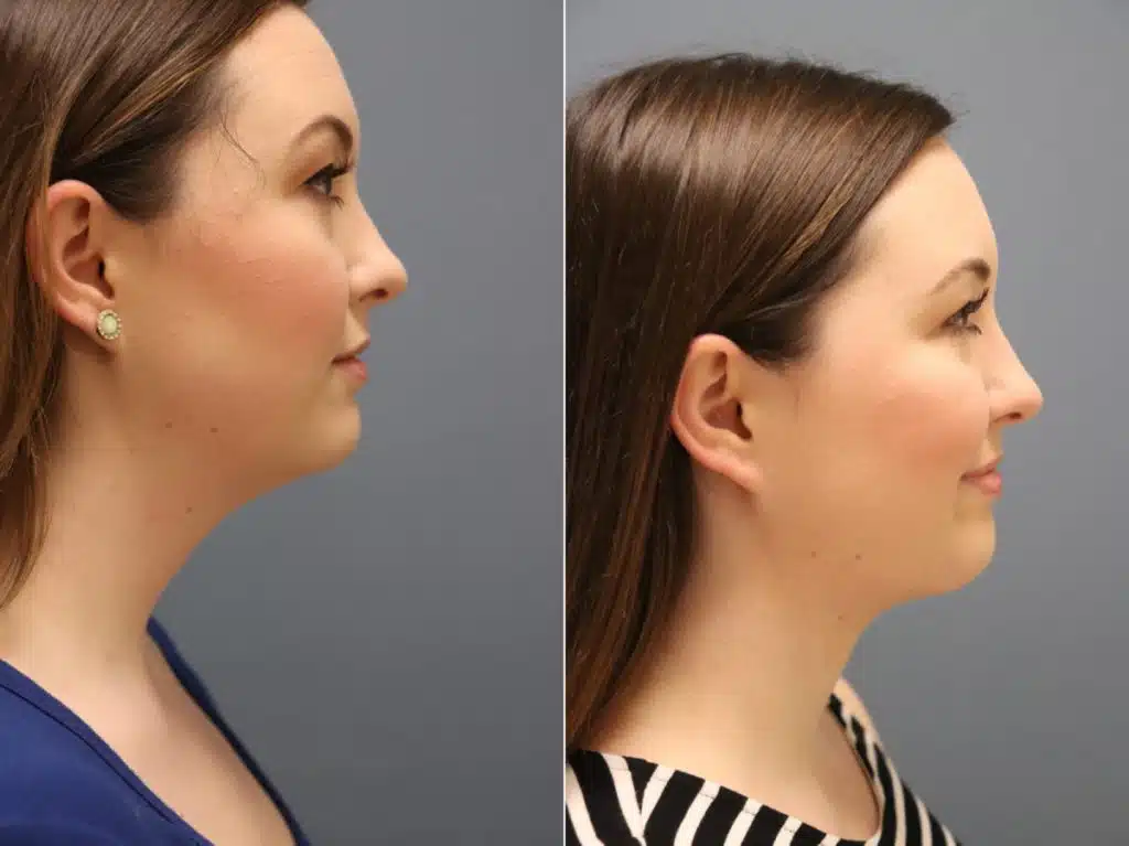 Submental Liposuction Before and After image