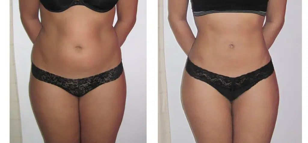 Flank Liposuction Before and After Pictures