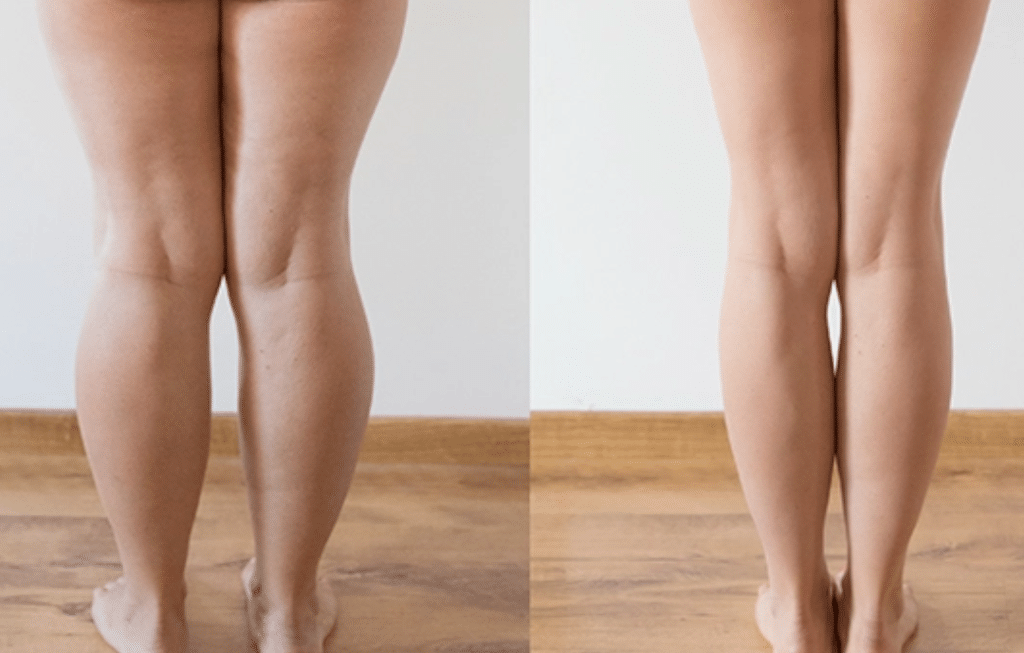 Liposucción de piernas antes y despues