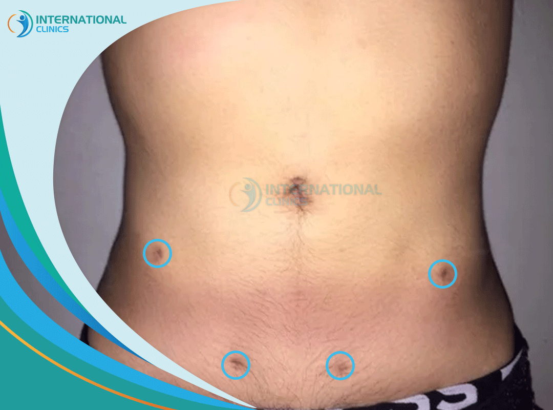 Male Liposuction Scars: Causes & Treatment 2024