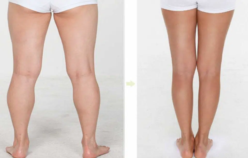 Calf Liposuction Before and After image