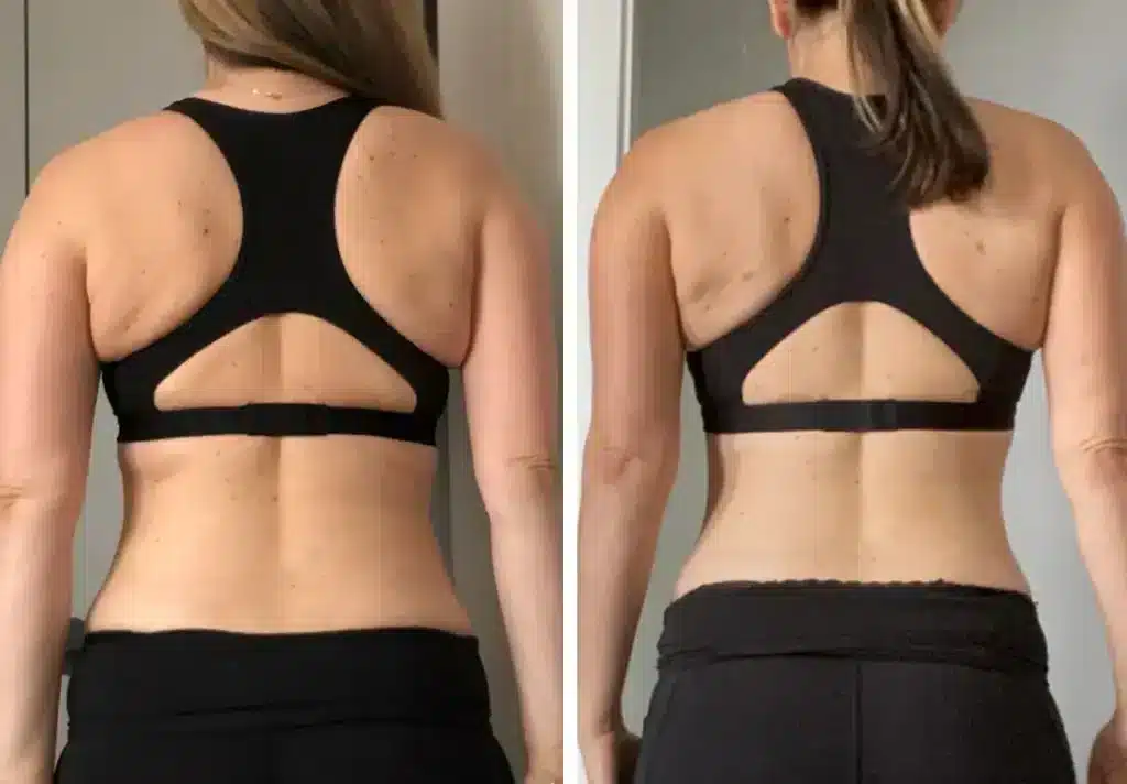 Liposucción de espalda Antes y despues