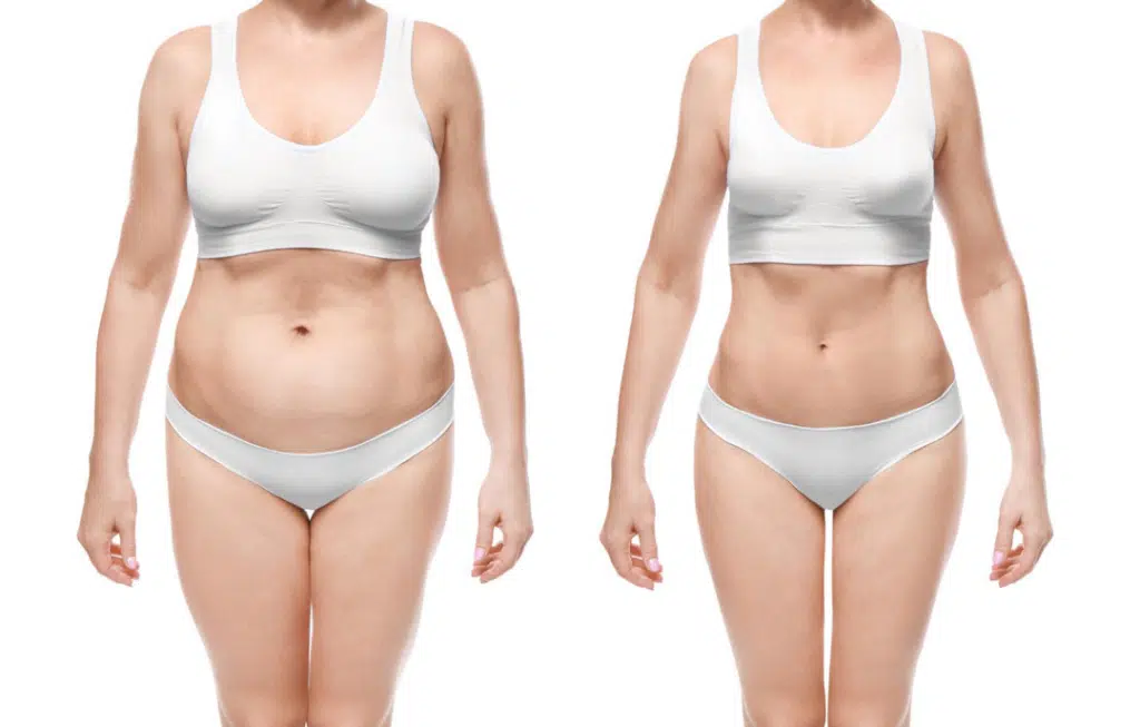 Belt Lipectomy Before and After