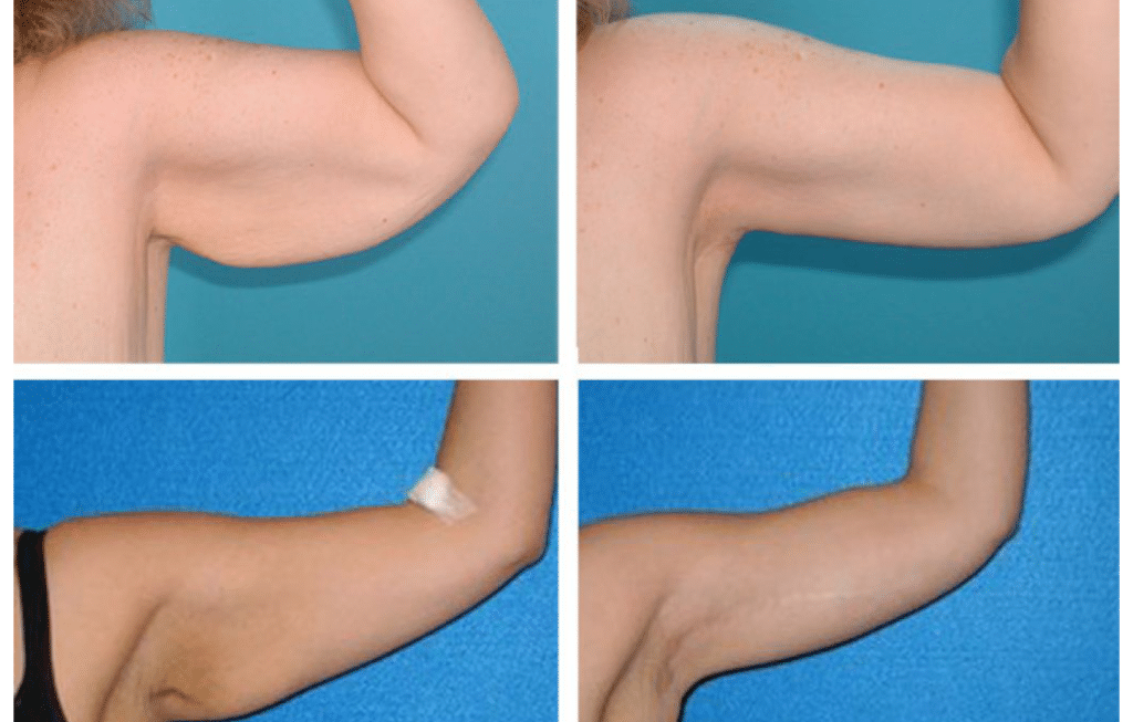 Arm Liposuction Results Week by Week
