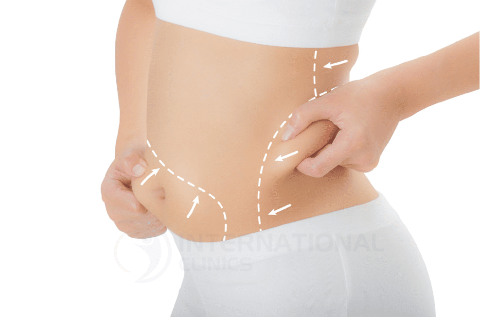 Flank Liposuction: Everything You Need to Know 2024 - International Clinics