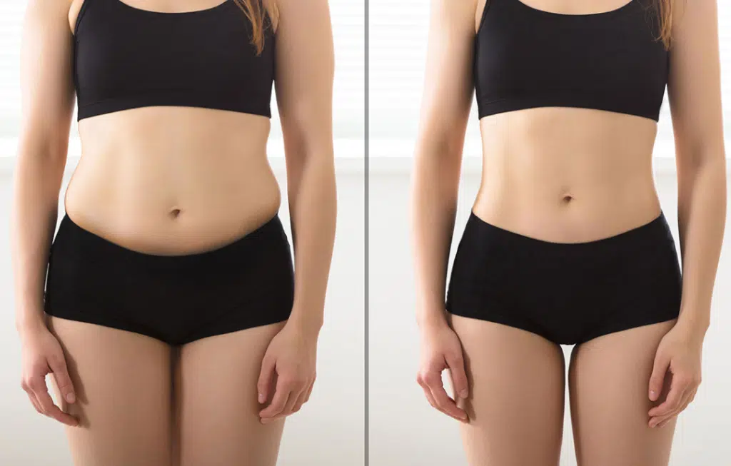 Hip Liposuction Before and After 