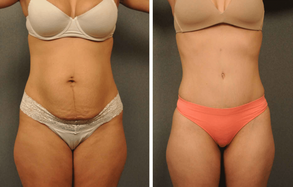 Liposuction Results Week by Week picture