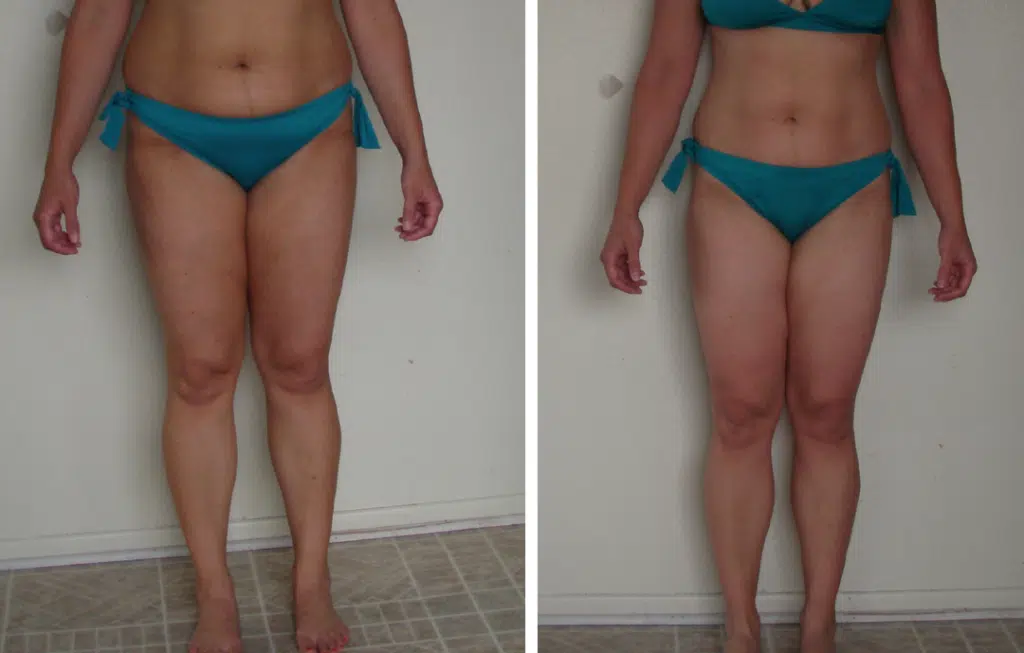 Hip Lipo Before and After 