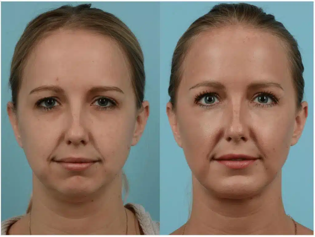 Antes y Después de una Liposucción Submentoniana