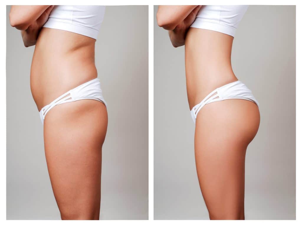 Thigh Liposuction Results Week by Week