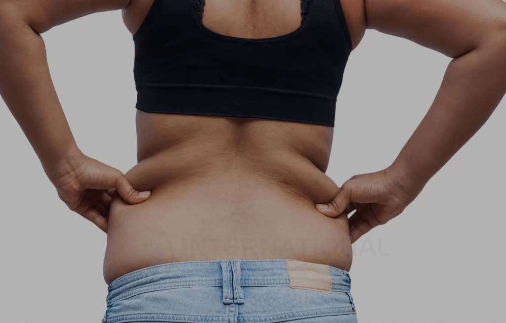 الآثار الجانبية لعملية شفط الدهون