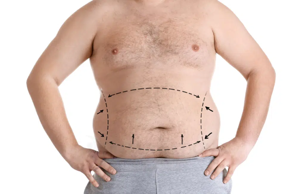 Full Upper Body Liposuction