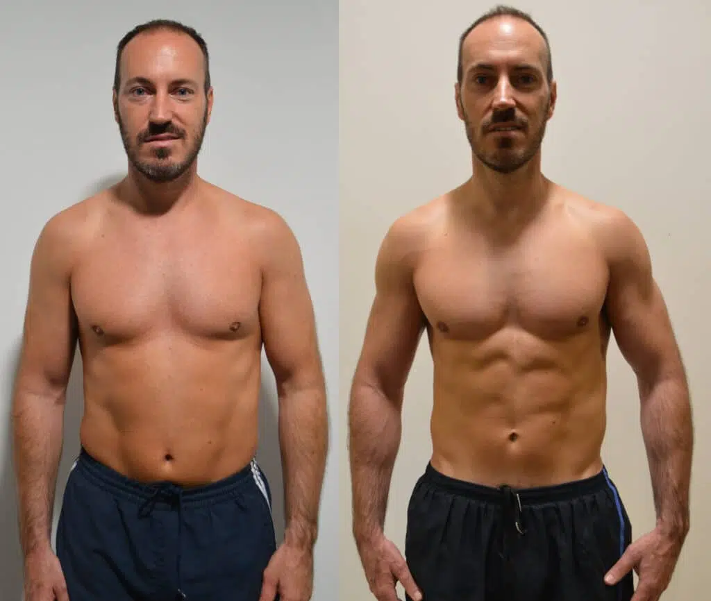 Upper Body Liposuction Before and After