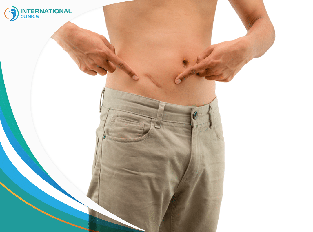 Male Liposuction Scars: Causes & Treatment 2023
