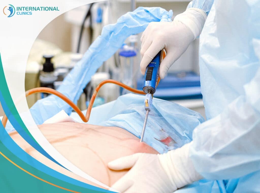 Everything You Need to Know About Laser Liposuction Procedures