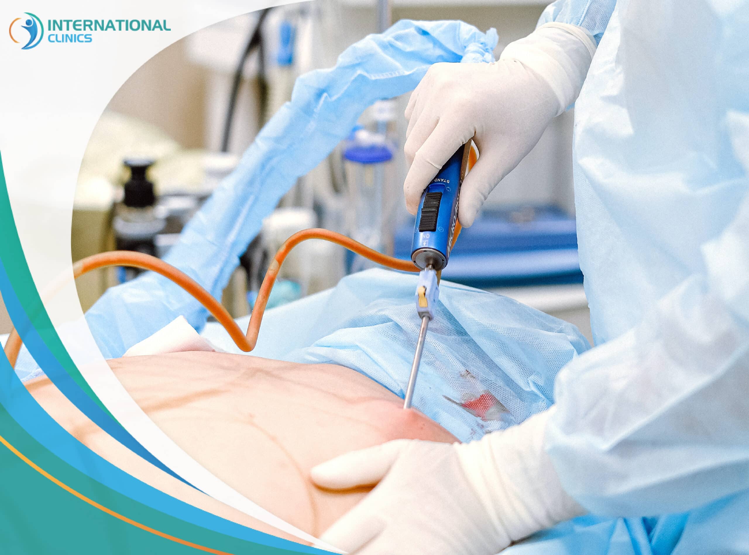 Liposuction Cannula: Everything You Need to Know 2023