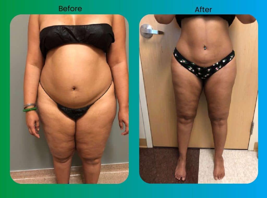  liposuction before and after photos