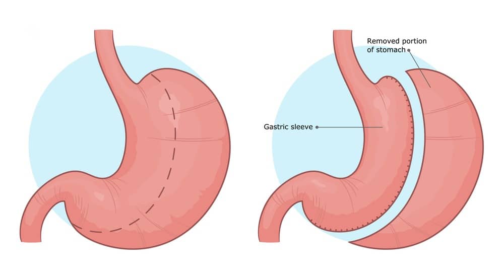 What Is Gastric Sleeve