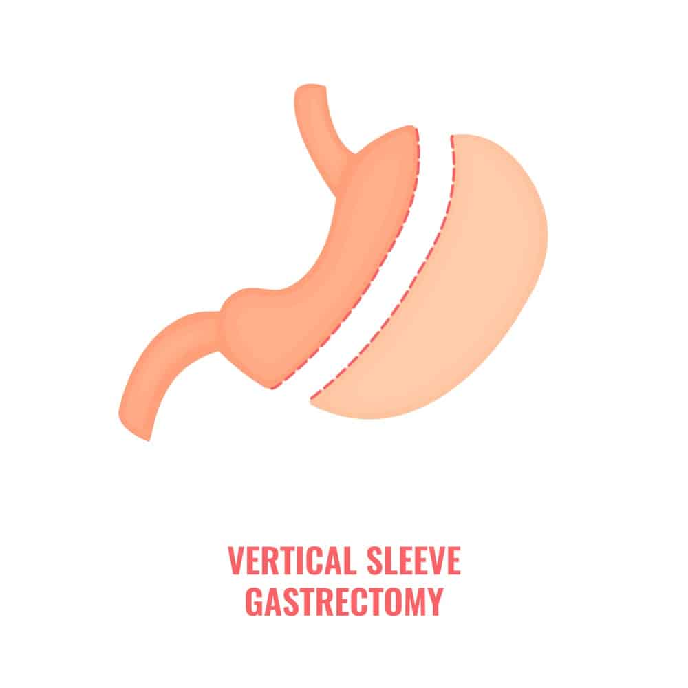 Gastric Sleeve Definition