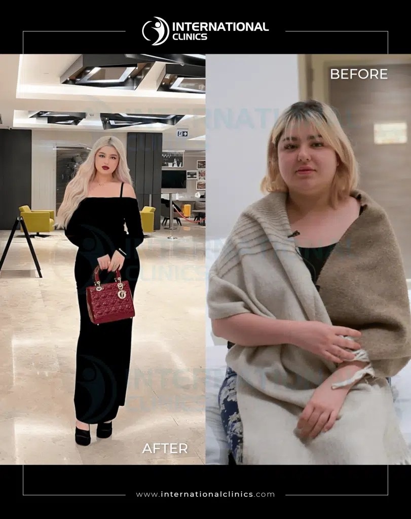 Gastric Sleeve in Turkey Before and After image